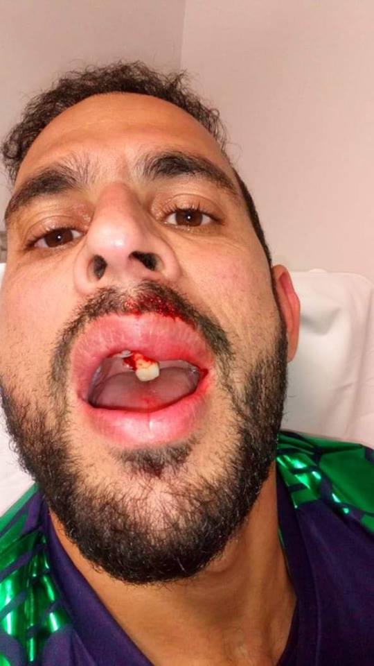 Fawad Ahmed Got Injured During The Match Against Peshawar Zalmi