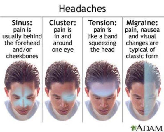 Types Of Headach - Science & Technology Images & Photos